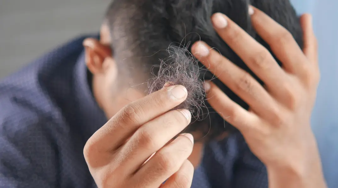 Επιστήμονες ανακάλυψαν επαναστατική «θεραπεία» για την τριχόπτωση που δρα σε μόλις 20 ημέρες – Πώς λειτουργεί