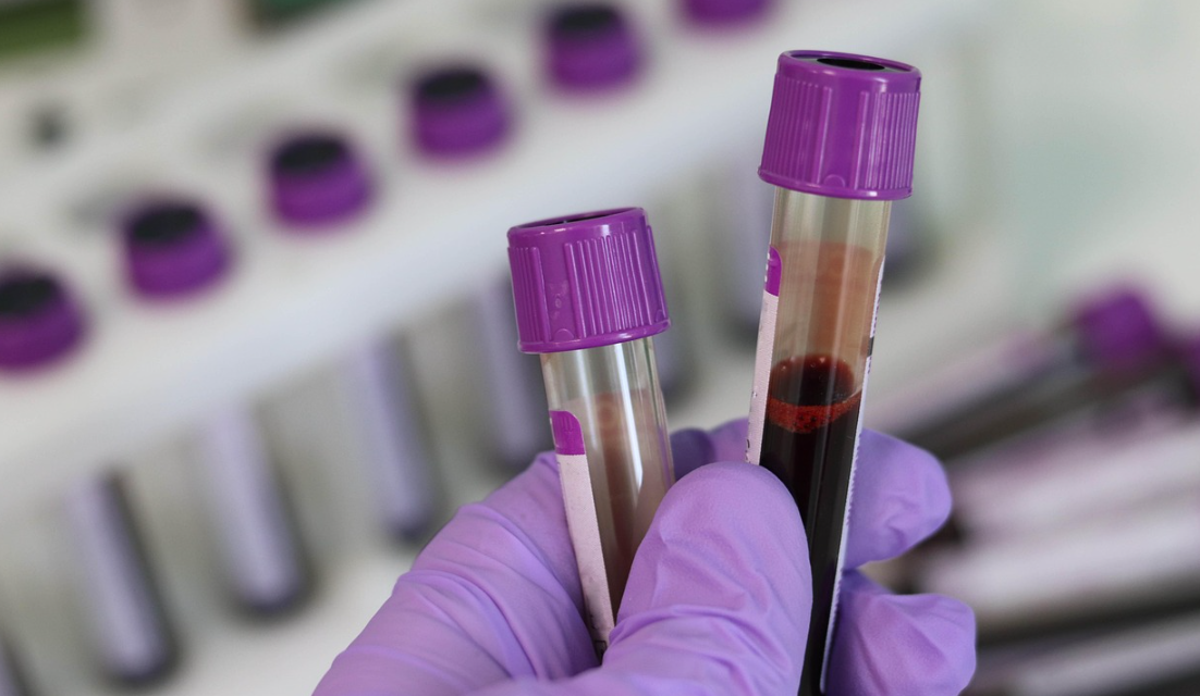 Παγκόσμια πρωτιά: Κυτταρική θεραπεία «επαναπρογραμμάτισε» το ανοσοποιητικό σύστημα μιας γυναίκας με τρία αυτοάνοσα νοσήματα