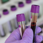 Παγκόσμια πρωτιά: Κυτταρική θεραπεία «επαναπρογραμμάτισε» το ανοσοποιητικό σύστημα μιας γυναίκας με τρία αυτοάνοσα νοσήματα